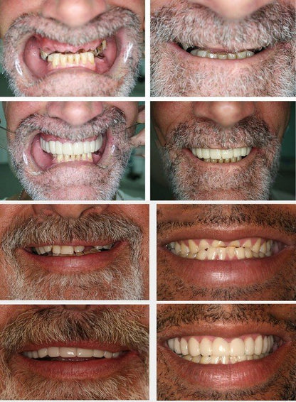 Adjustable Snap-On Dentures 🔥🎉 HOT SALE